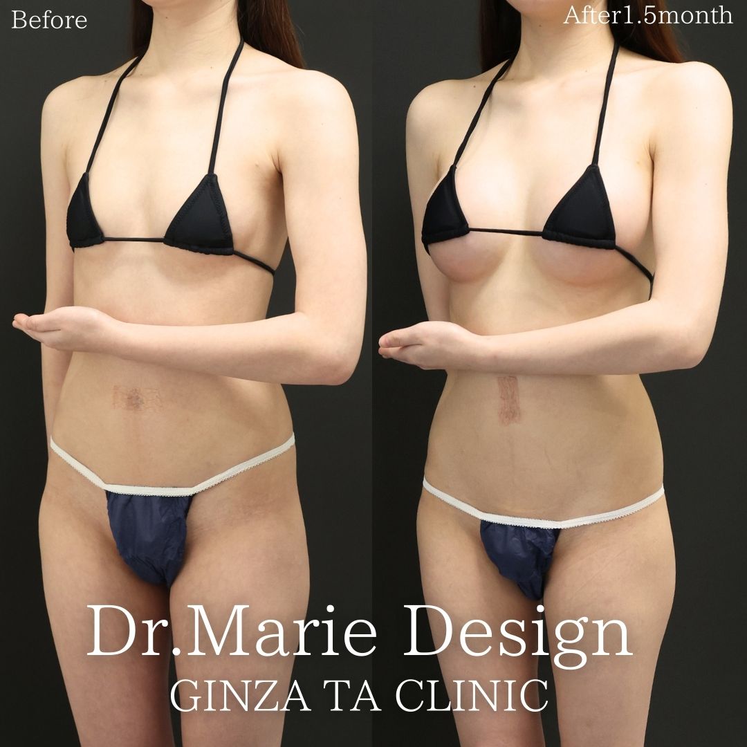 シリコンバッグ豊胸（人工乳腺バッグ）の症例写真 施術前後 