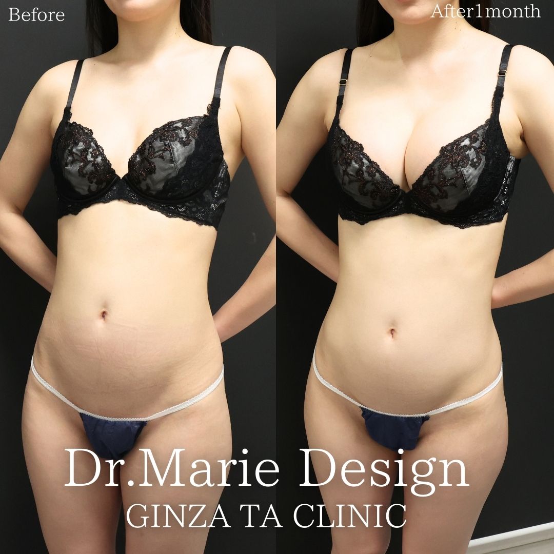 シリコンバッグ豊胸（人工乳腺バッグ）の症例写真 施術前後 