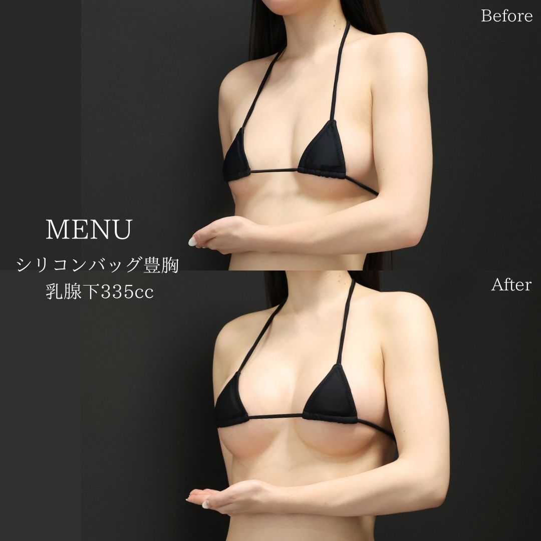 シリコンバッグ豊胸（人工乳腺バッグ）の症例写真 施術前後 