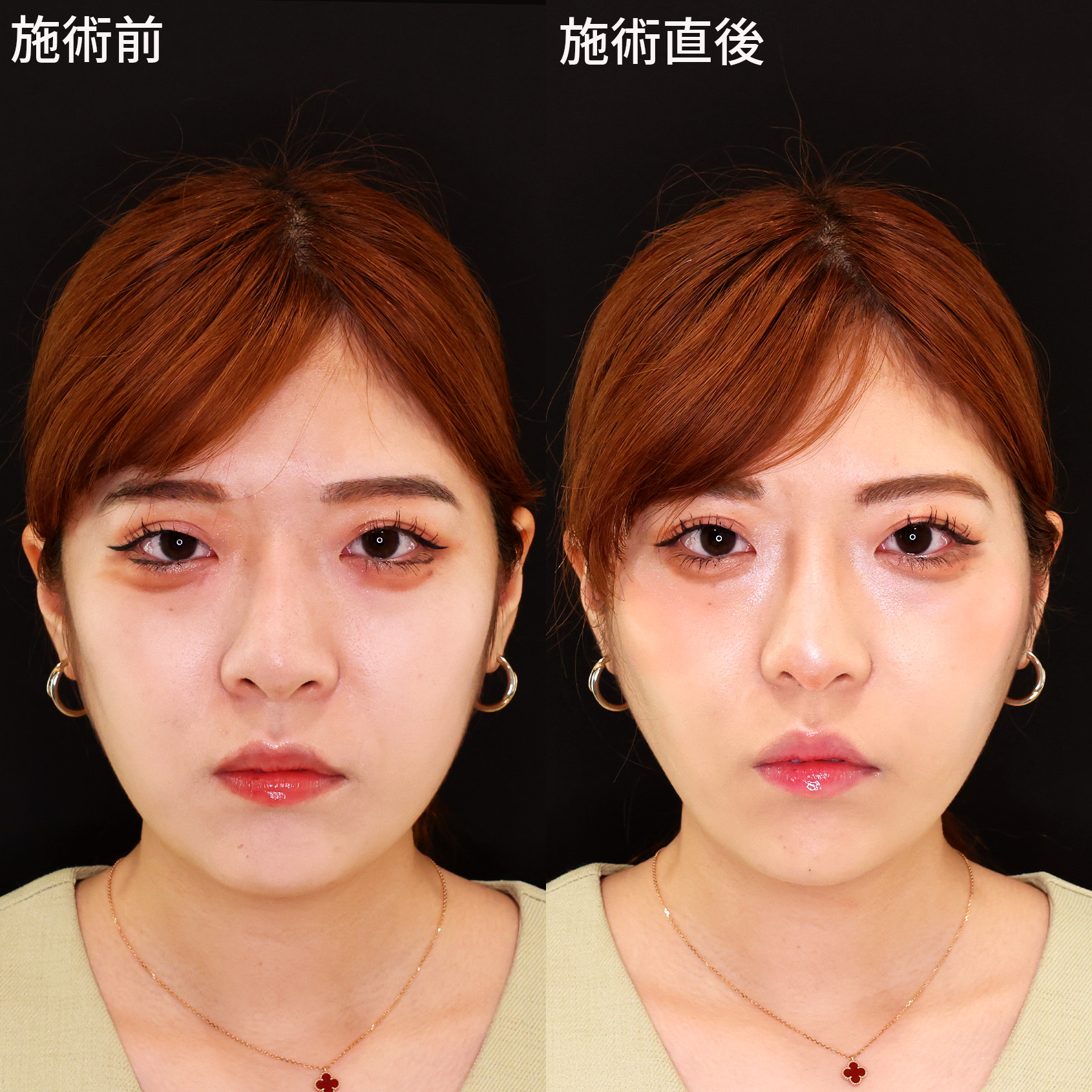 術直後でこの美しさ！ダウンタイム最小限の小顔術