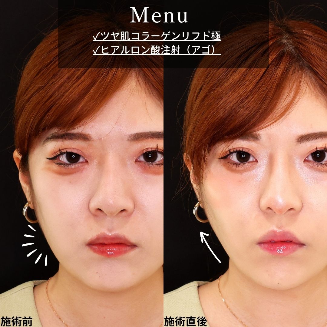 TAC式 ツヤ肌コラーゲンリフト®/顎のヒアルロン酸注射の症例写真 施術前後 