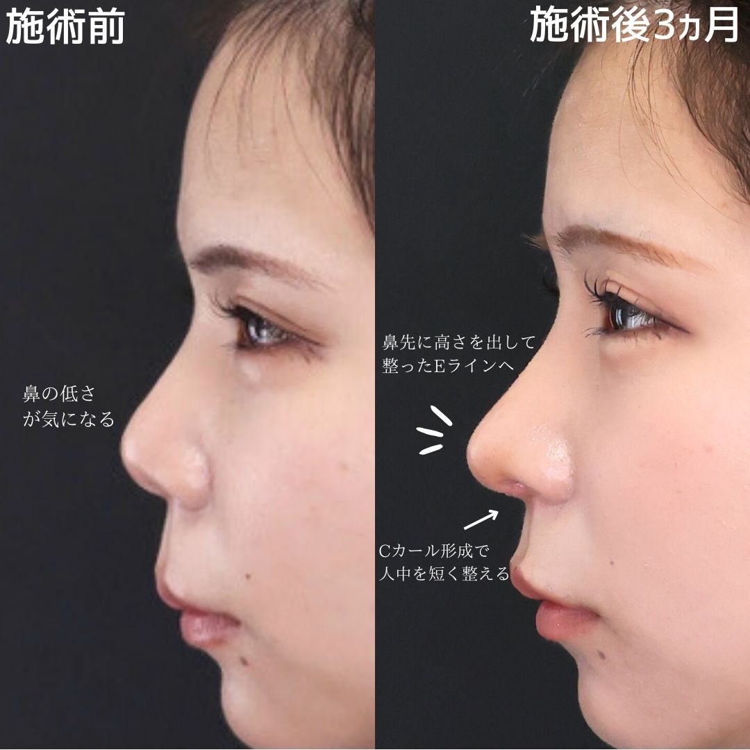 鼻尖形成・鼻尖縮小/鼻先軟骨移植/鼻中隔延長術の症例写真 施術前後 