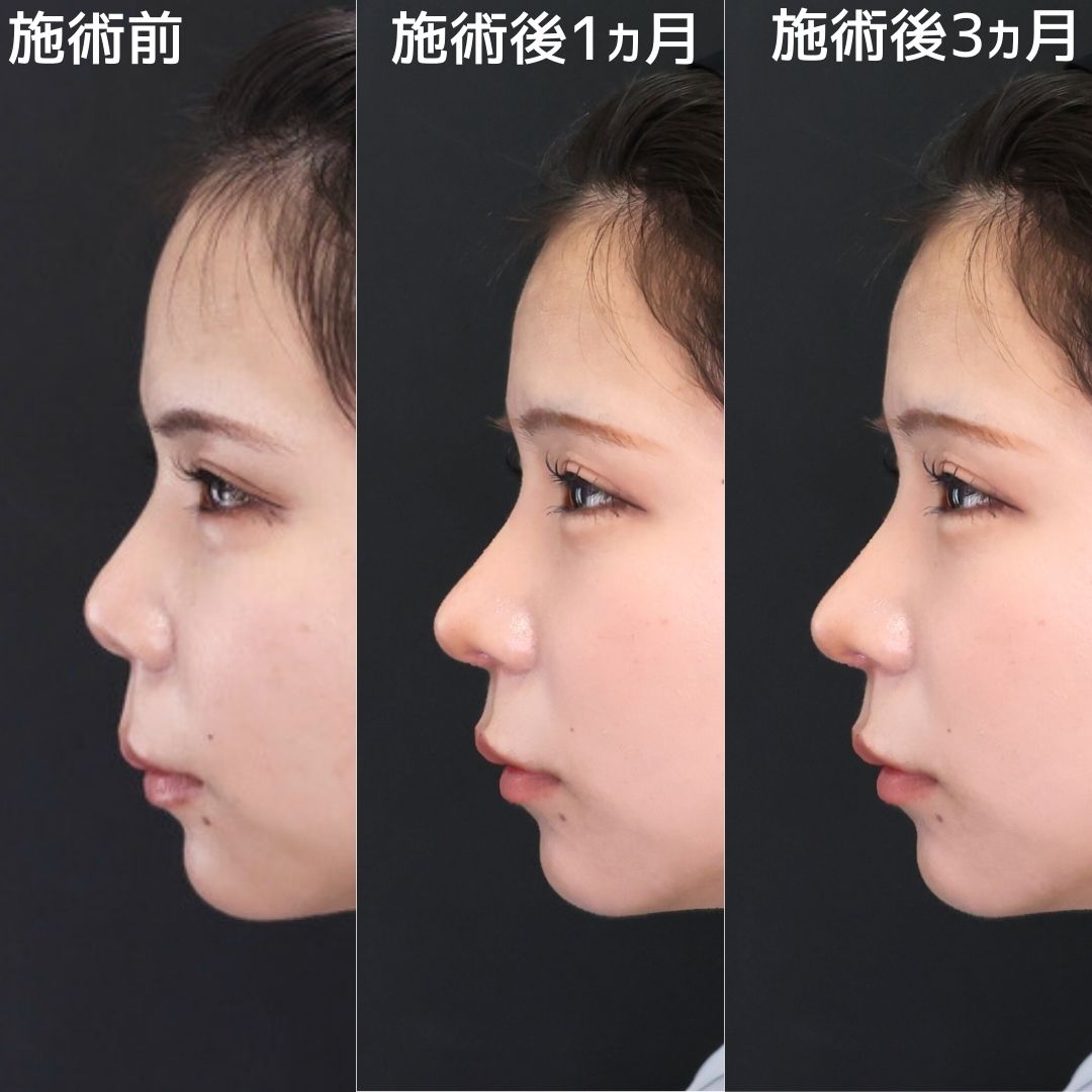 鼻尖形成・鼻尖縮小/鼻先軟骨移植/鼻中隔延長術の症例写真 施術前後 