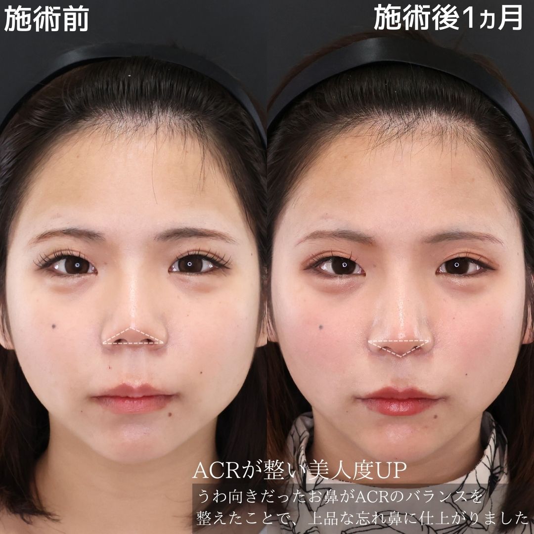 鼻尖形成・鼻尖縮小/鼻先軟骨移植/鼻中隔延長術の症例写真 施術前後 