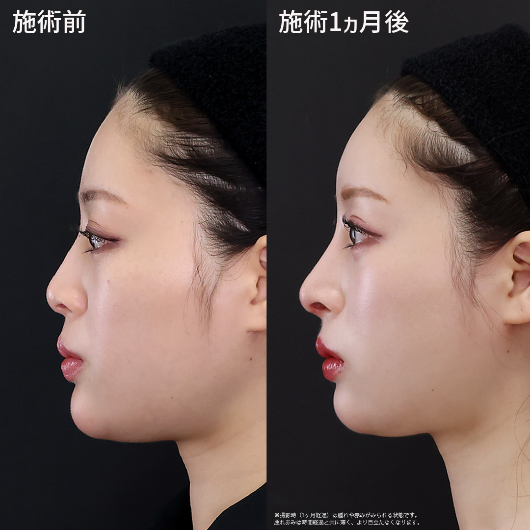 【整形感のない自然な仕上がりの鼻整形】口元の突出感が改善、整ったEラインで魅せる美しい横顔