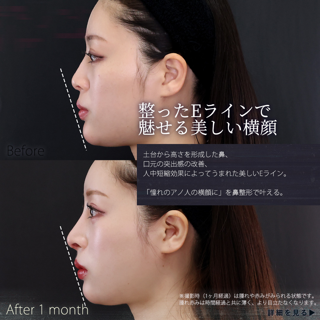 鼻中隔延長術/鼻先軟骨移植/鼻尖形成・鼻尖縮小の症例写真 施術前後 