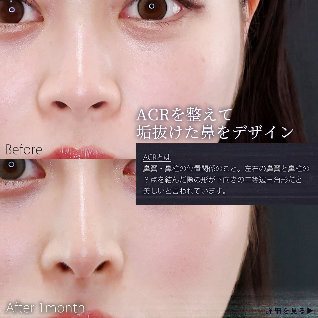 鼻中隔延長術/鼻先軟骨移植/鼻尖形成・鼻尖縮小の症例写真 施術前後 