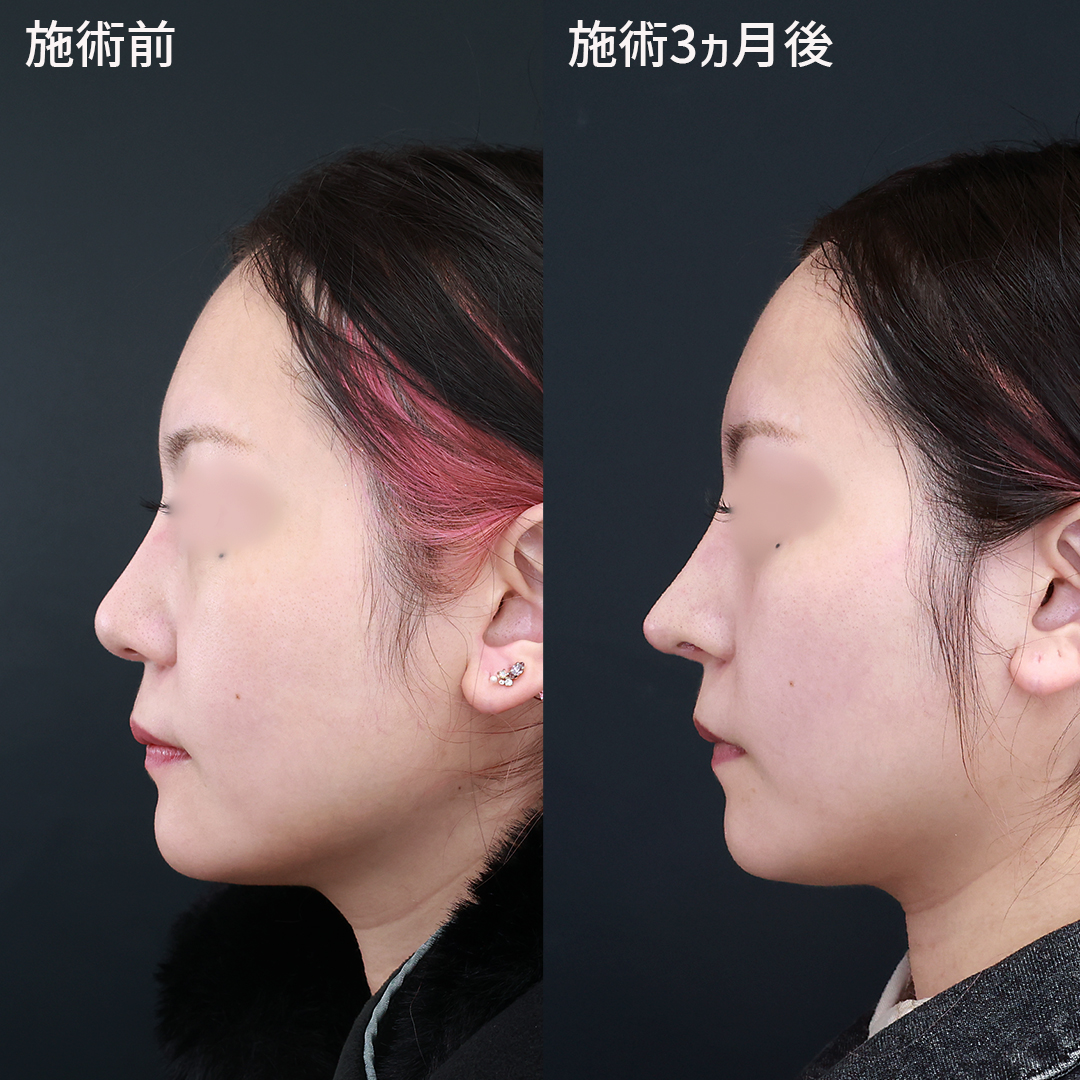 こだわり抜いたデザインでつくるメリハリの効いた鼻整形
