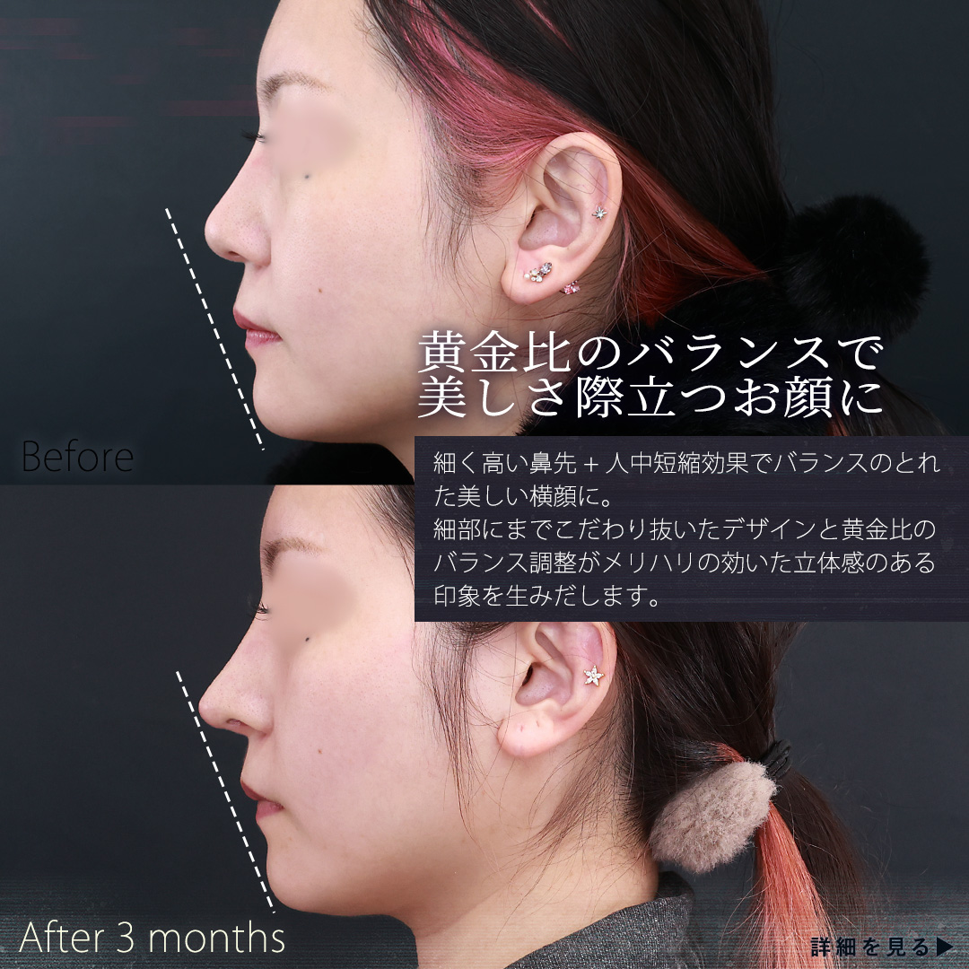 鼻中隔延長術/鼻先軟骨移植/鼻尖形成・鼻尖縮小の症例写真 施術前後