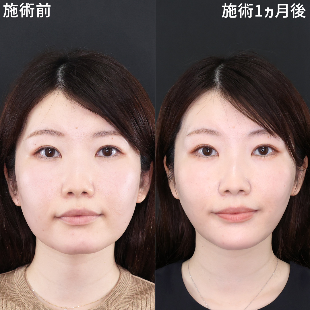 理想の卵型フェイスライン｜Dr.奥津のパーフェクトフェイスライン