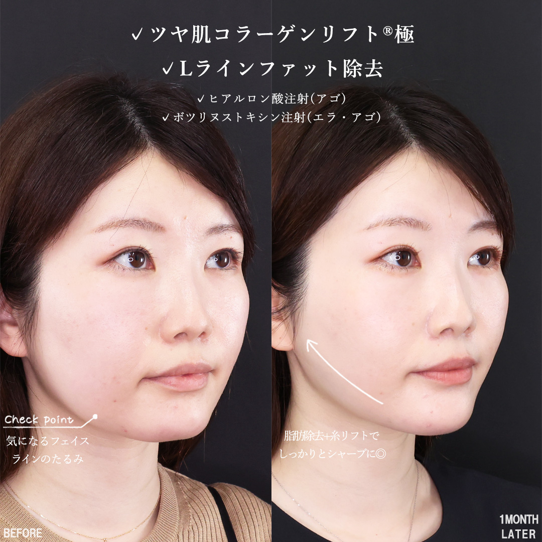 TAC式 ツヤ肌コラーゲンリフト®/Lラインファット除去（エラ下脂肪除去）/顎のヒアルロン酸注射の症例写真 施術前後 