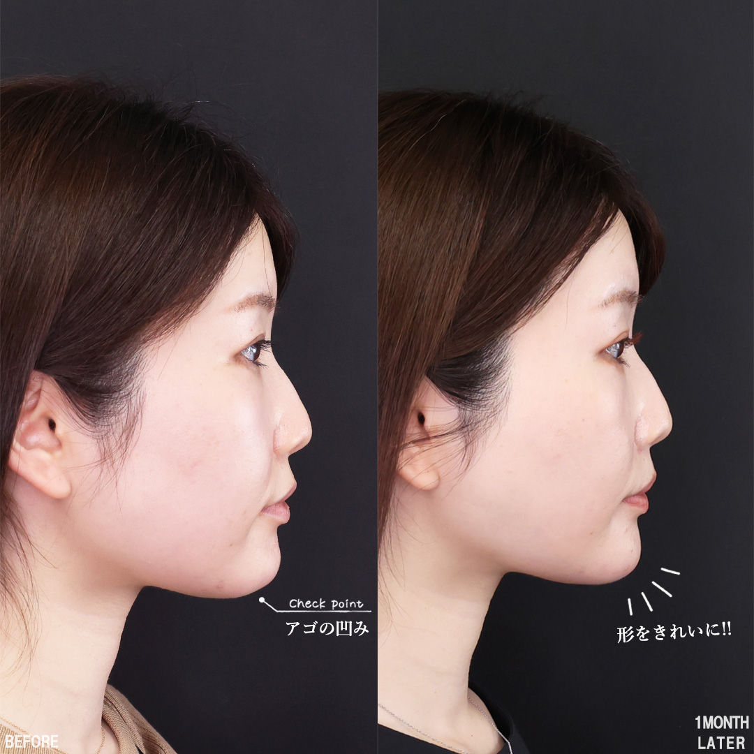 TAC式 ツヤ肌コラーゲンリフト®/Lラインファット除去（エラ下脂肪除去）/顎のヒアルロン酸注射の症例写真 施術前後 