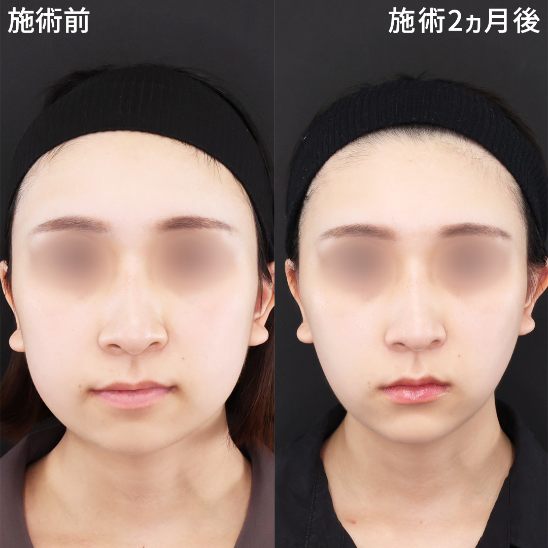 気になる顔の余白を軽減｜自然な顔痩せ小顔術