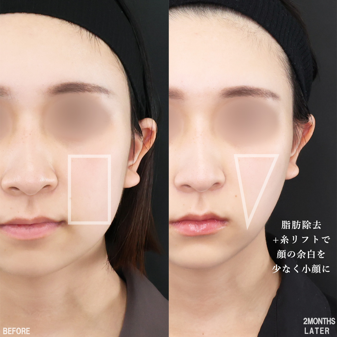 TAC式 ツヤ肌コラーゲンリフト®/ジョールファット除去/バッカルファット除去の症例写真 施術前後 