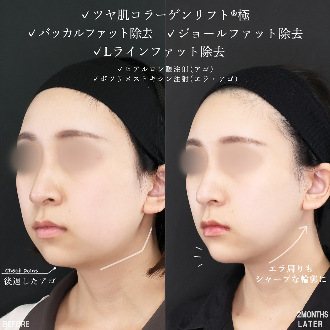 TAC式 ツヤ肌コラーゲンリフト®/ジョールファット除去/バッカルファット除去の症例写真 施術前後 