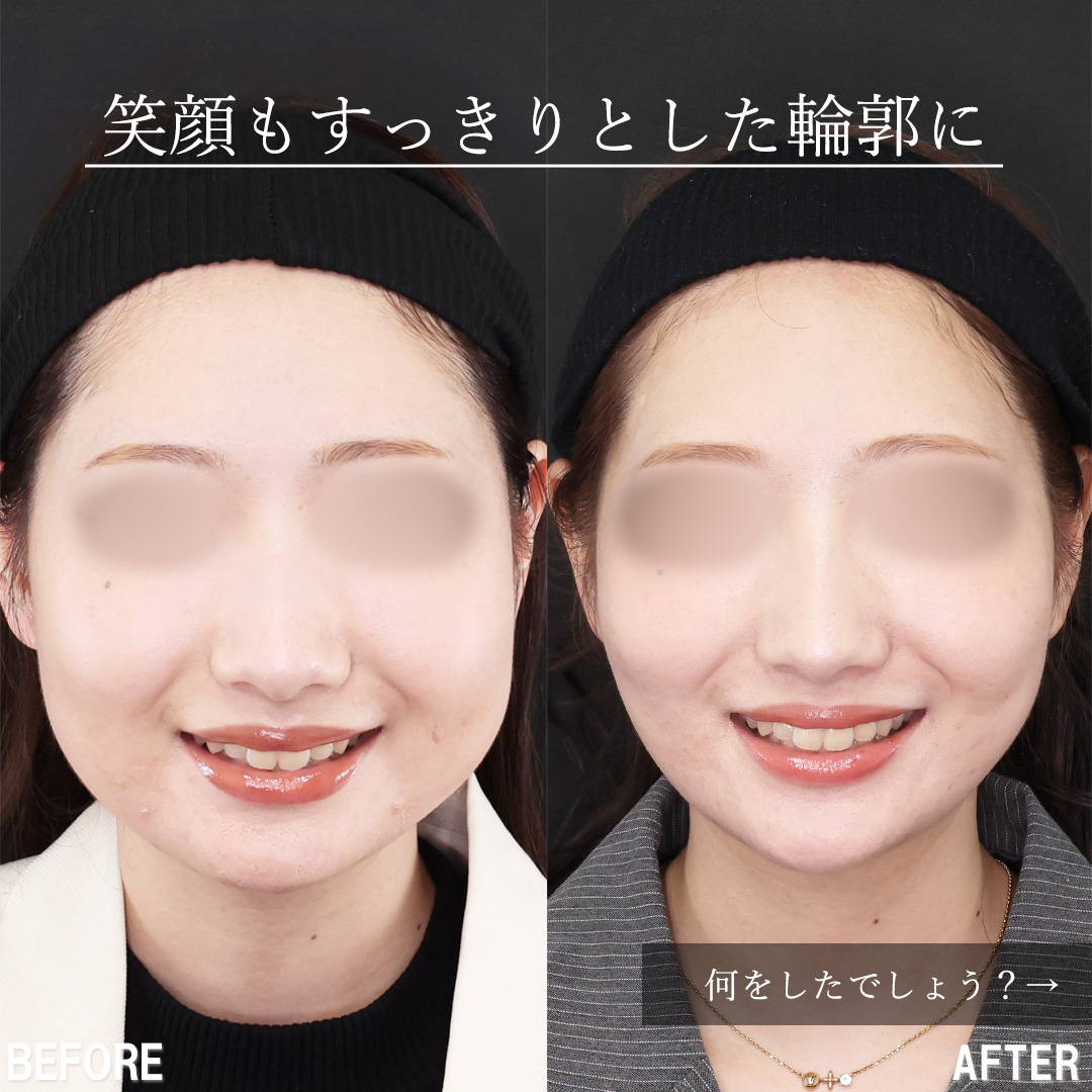 TAC式 ツヤ肌コラーゲンリフト®/バッカルファット除去/Lラインファット除去（エラ下脂肪除去）の症例写真 施術前後 