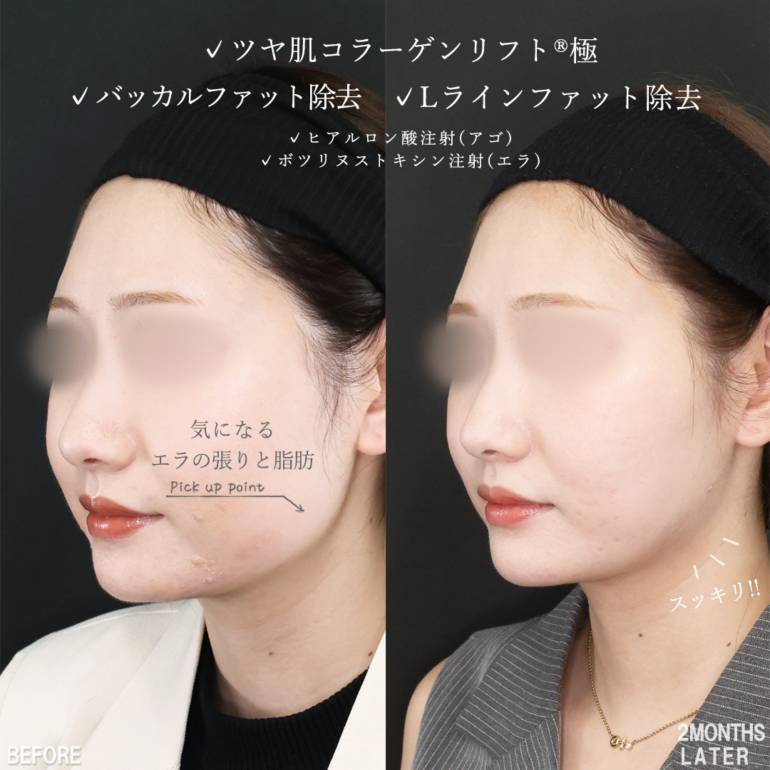 TAC式 ツヤ肌コラーゲンリフト®/バッカルファット除去/Lラインファット除去（エラ下脂肪除去）の症例写真 施術前後 