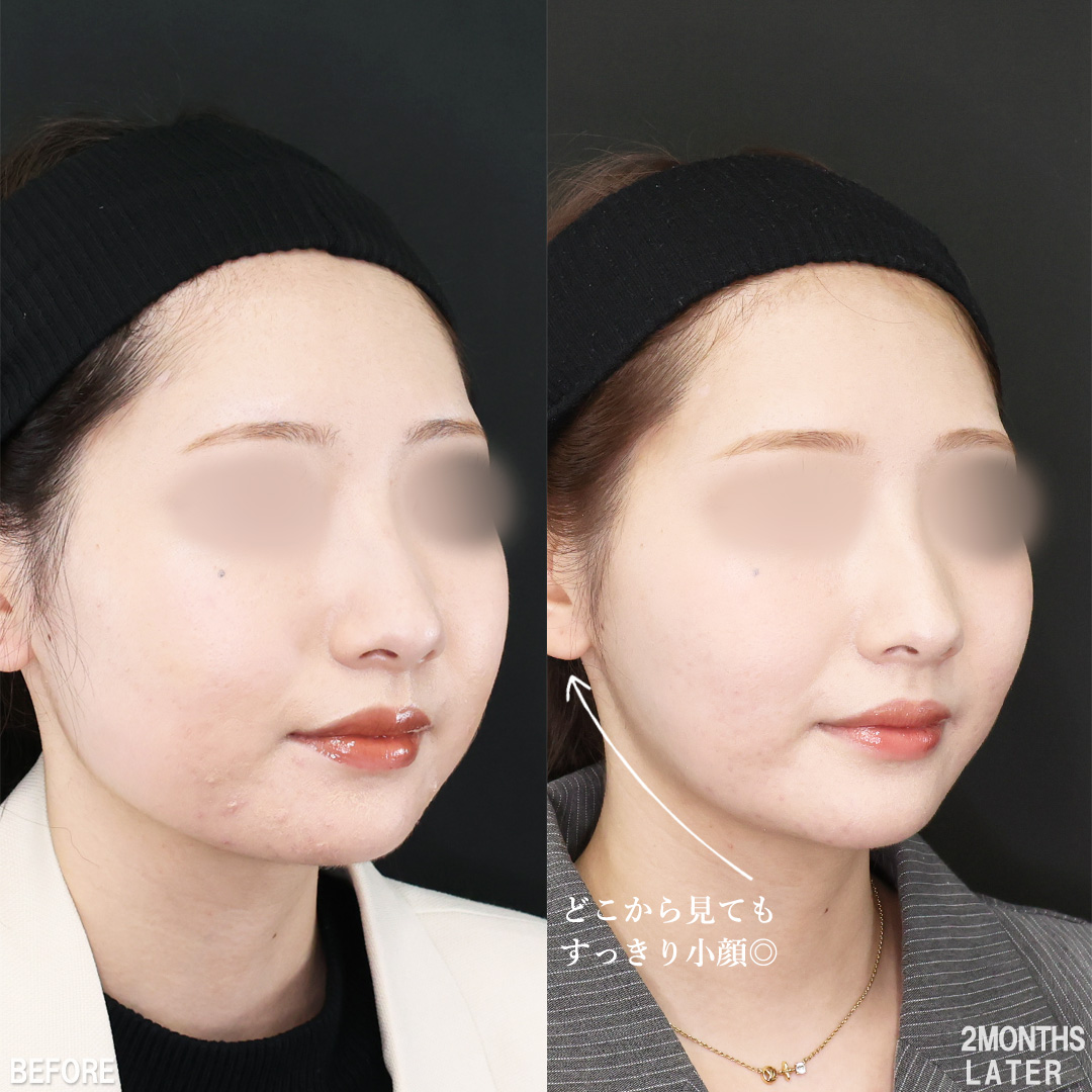 TAC式 ツヤ肌コラーゲンリフト®/バッカルファット除去/Lラインファット除去（エラ下脂肪除去）の症例写真 施術前後 