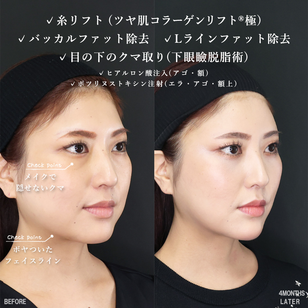 下眼瞼脱脂術（目の下のたるみ取り・目の下の脂肪ふくらみ取り）/TAC式 ツヤ肌コラーゲンリフト®/バッカルファット除去の症例写真 施術前後 