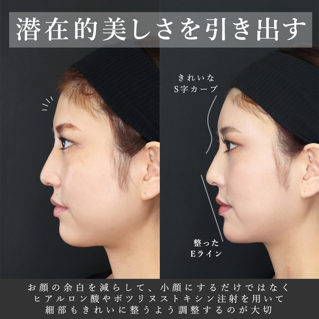 下眼瞼脱脂術（目の下のたるみ取り・目の下の脂肪ふくらみ取り）/TAC式 ツヤ肌コラーゲンリフト®/バッカルファット除去の症例写真 施術前後 