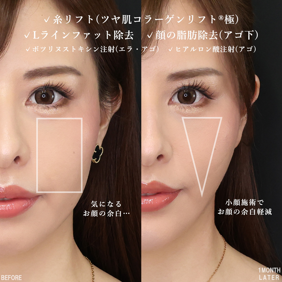 TAC式 ツヤ肌コラーゲンリフト®/顔の脂肪吸引/Lラインファット除去（エラ下脂肪除去）の症例写真 施術前後 