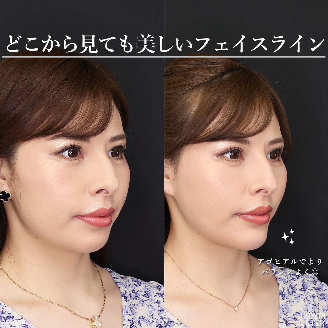 TAC式 ツヤ肌コラーゲンリフト®/顔の脂肪吸引/Lラインファット除去（エラ下脂肪除去）の症例写真 施術前後 