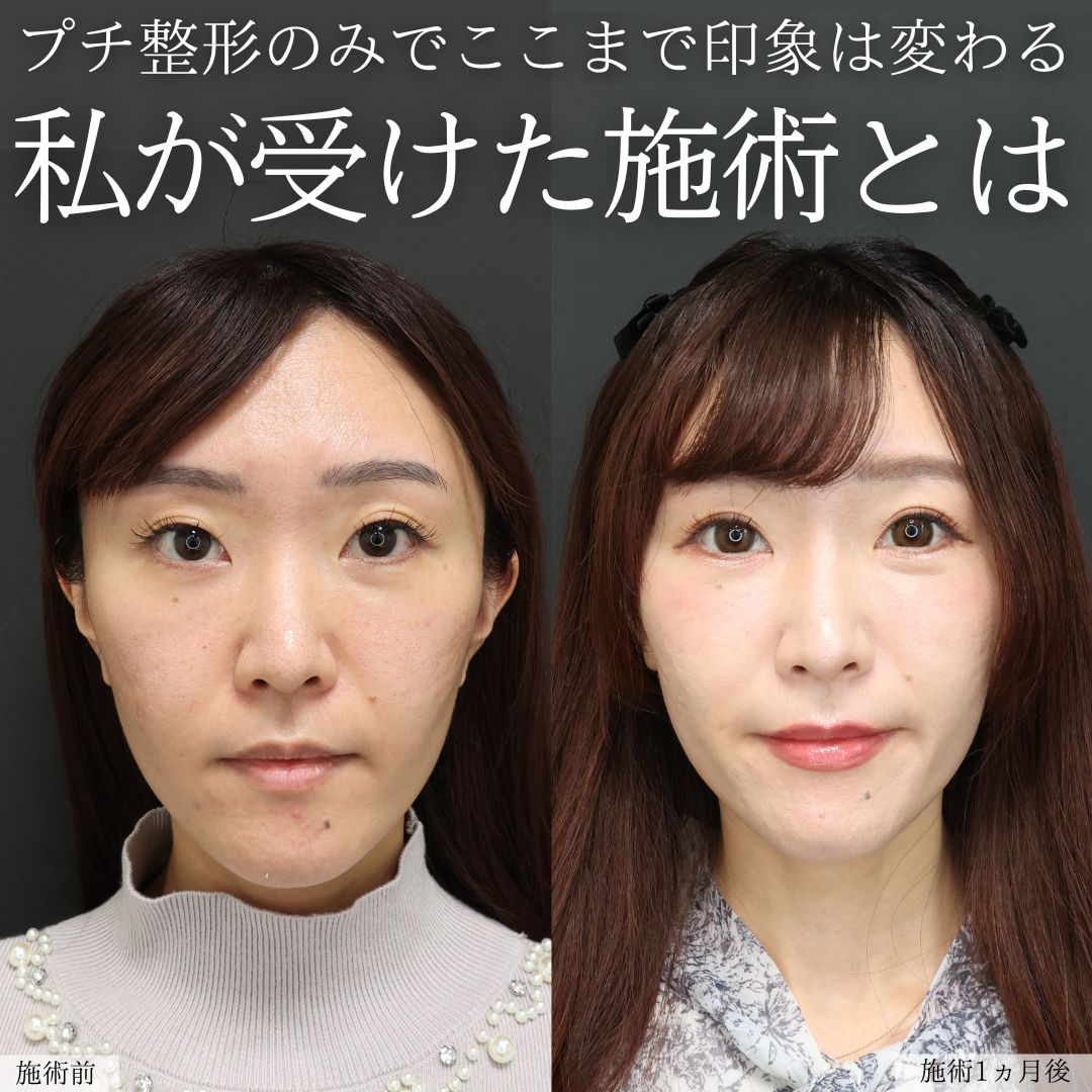 二重埋没法の症例写真 施術前後 