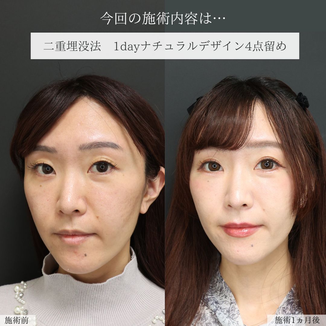 二重埋没法の症例写真 施術前後 