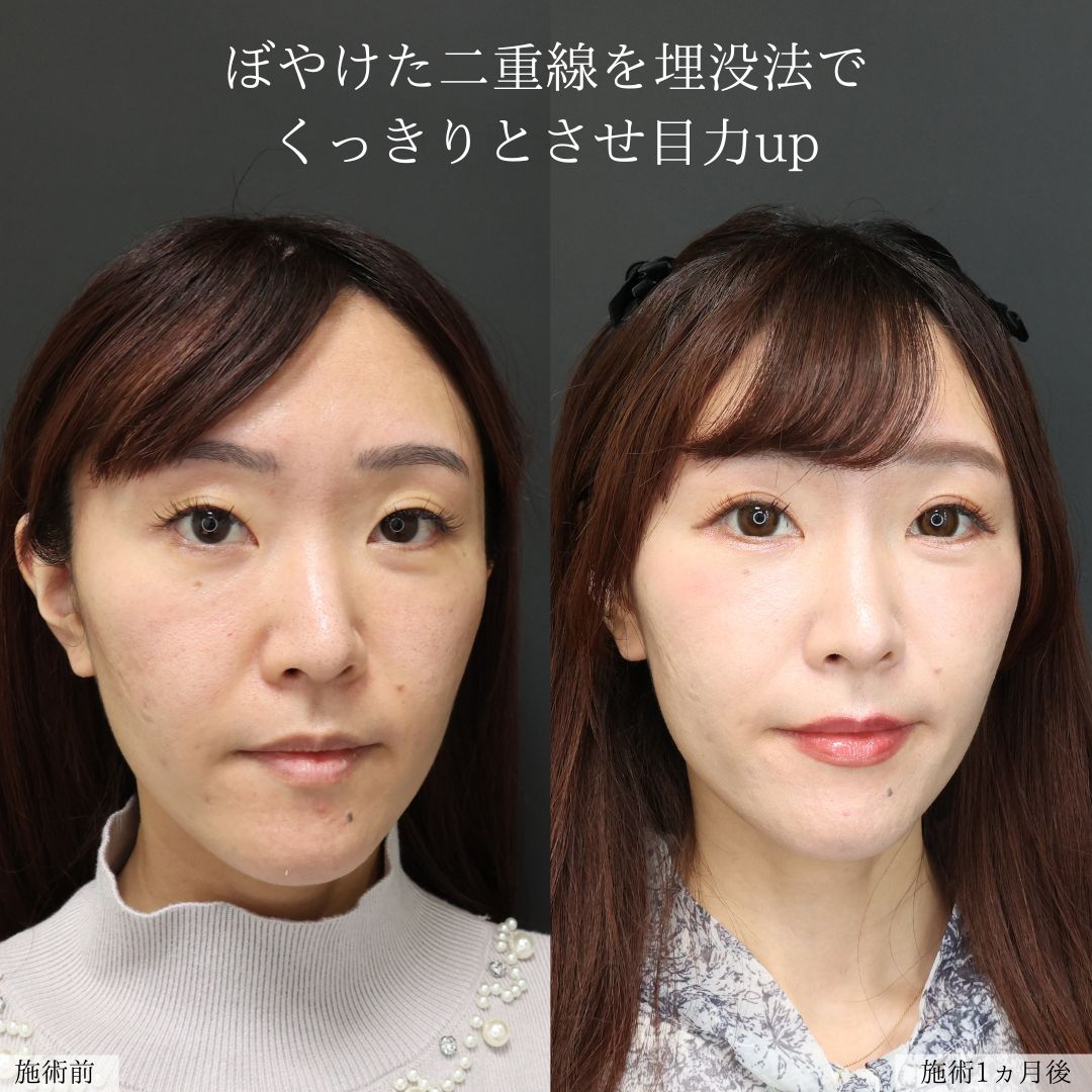 二重埋没法の症例写真 施術前後 