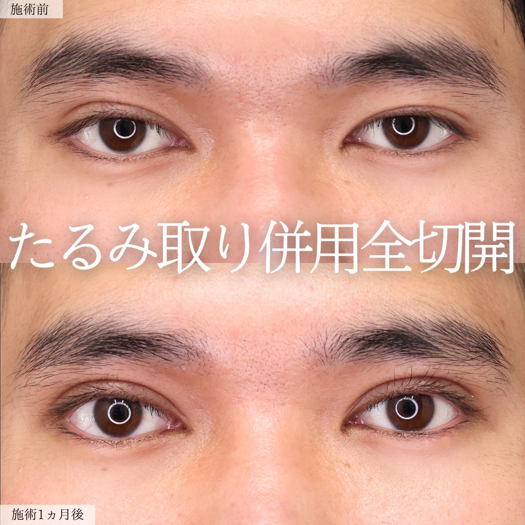 上眼瞼切開術の症例写真 施術前後 