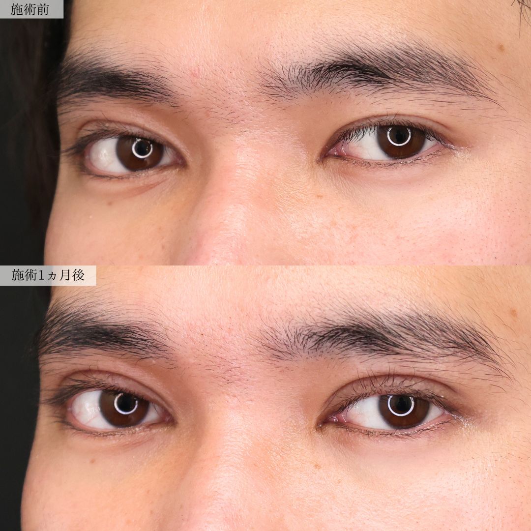 上眼瞼切開術の症例写真 施術前後 