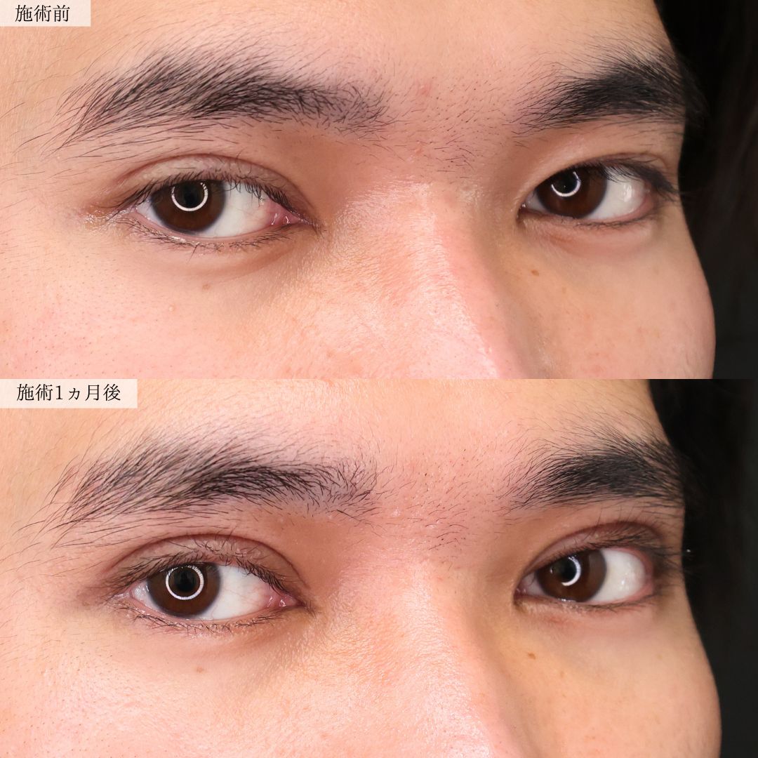 上眼瞼切開術の症例写真 施術前後 