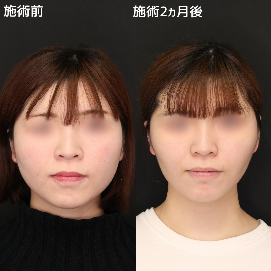 《オーダーメイド小顔術》で自慢の笑顔に