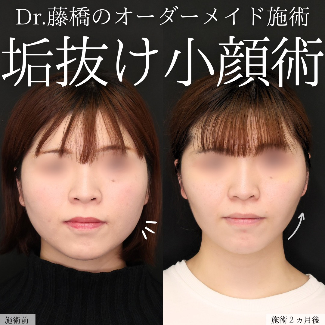 TAC式 ツヤ肌コラーゲンリフト®/ジョールファット除去/バッカルファット除去の症例写真 施術前後 