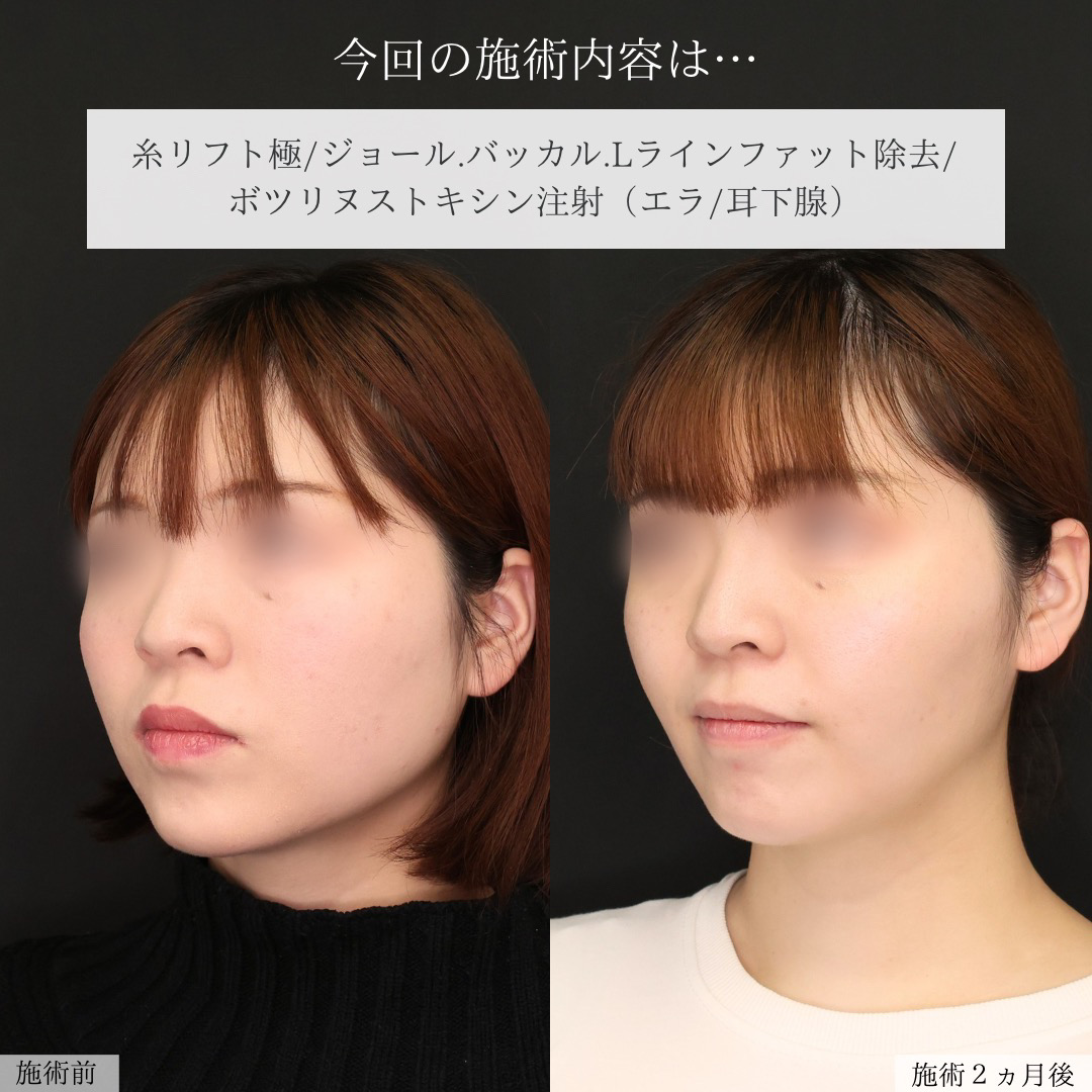 TAC式 ツヤ肌コラーゲンリフト®/ジョールファット除去/バッカルファット除去の症例写真 施術前後 