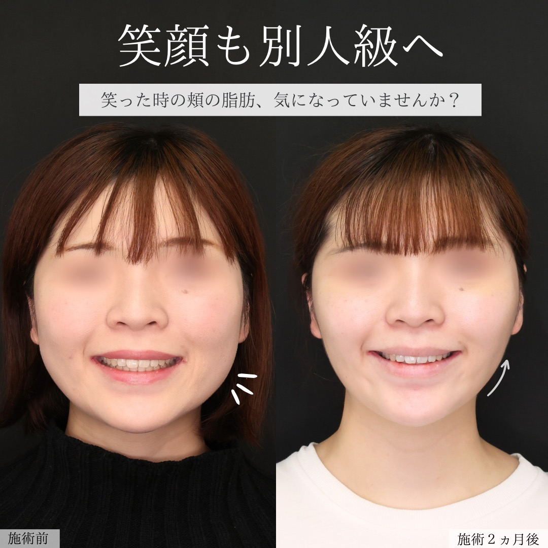 TAC式 ツヤ肌コラーゲンリフト®/ジョールファット除去/バッカルファット除去の症例写真 施術前後 