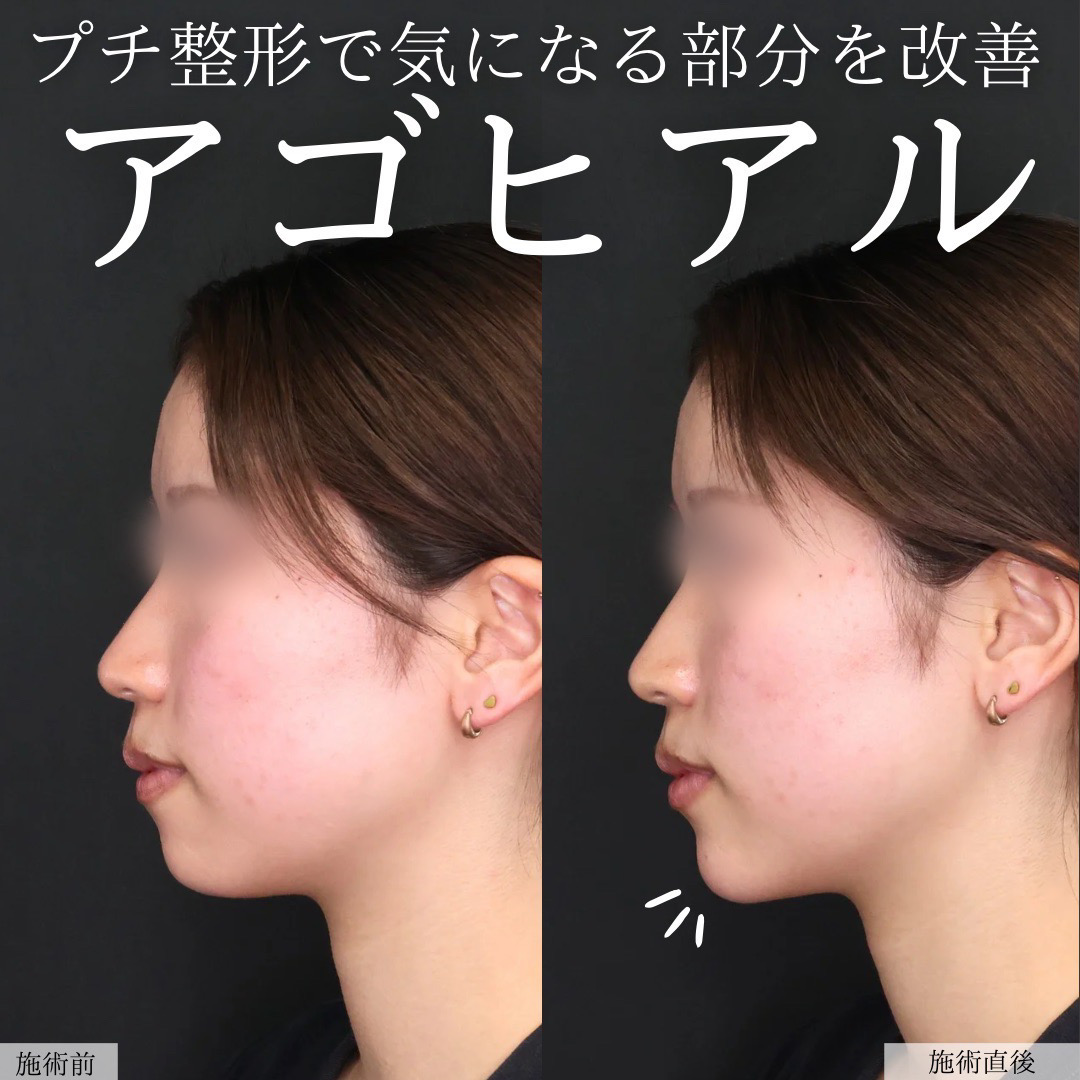 顎のヒアルロン酸注射/エラボトックス注射の症例写真 施術前後