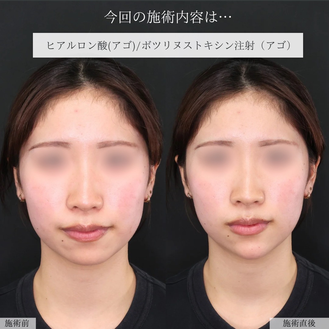 顎のヒアルロン酸注射/エラボトックス注射の症例写真 施術前後