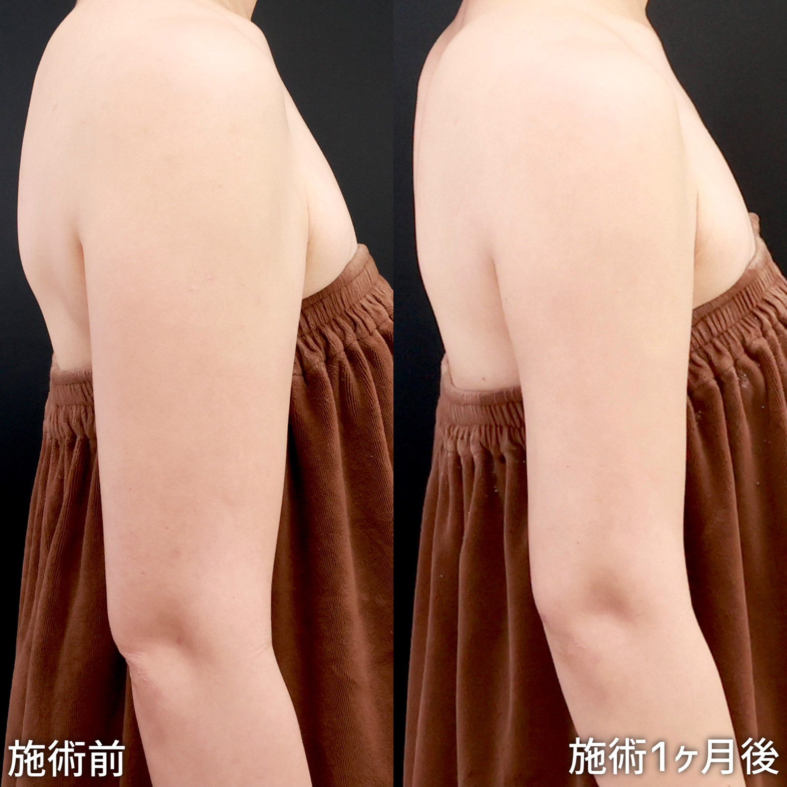 【二の腕脂肪吸引】厚みのある上半身をスッキリとさせて、華奢見せ！