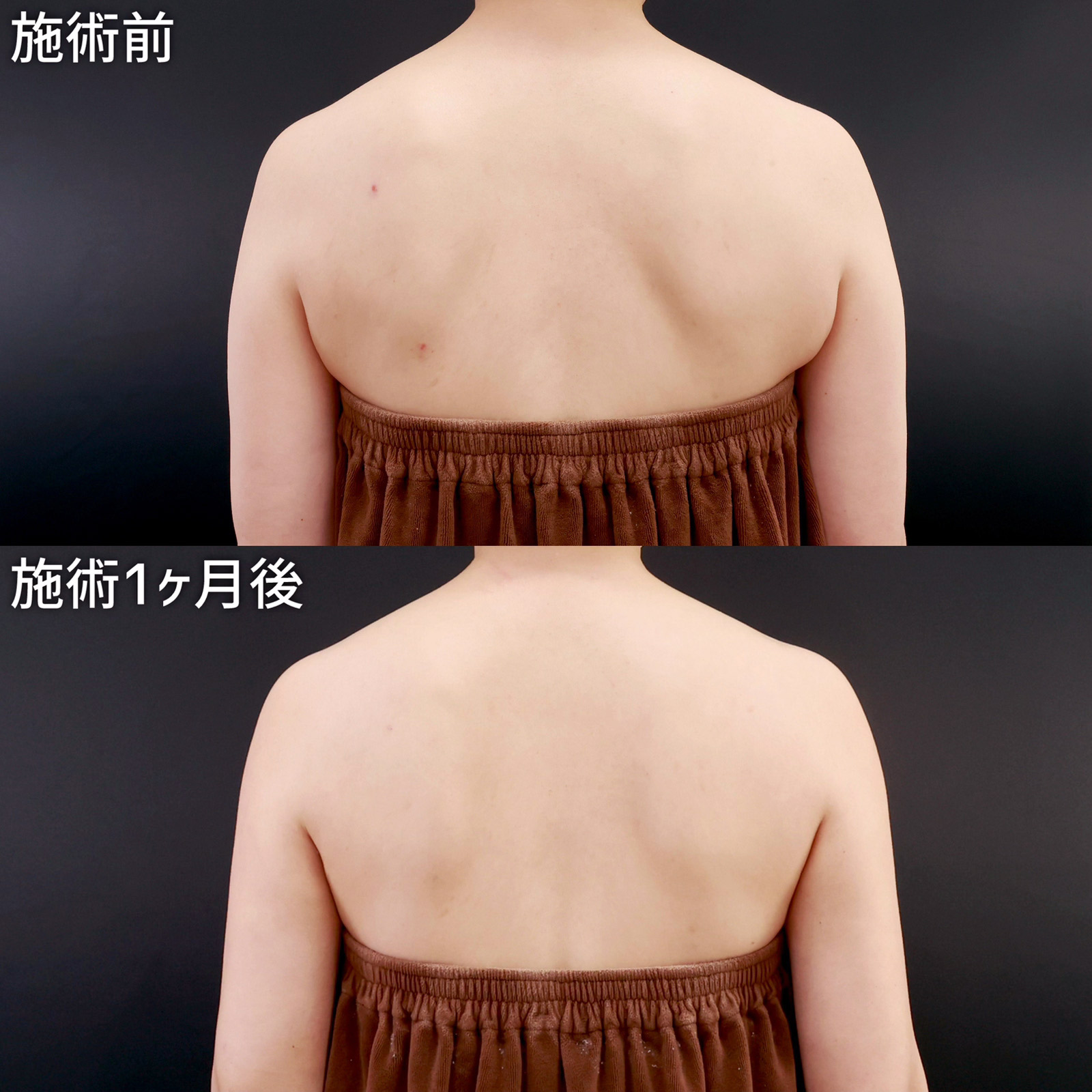 体の脂肪吸引の症例写真 施術前後 