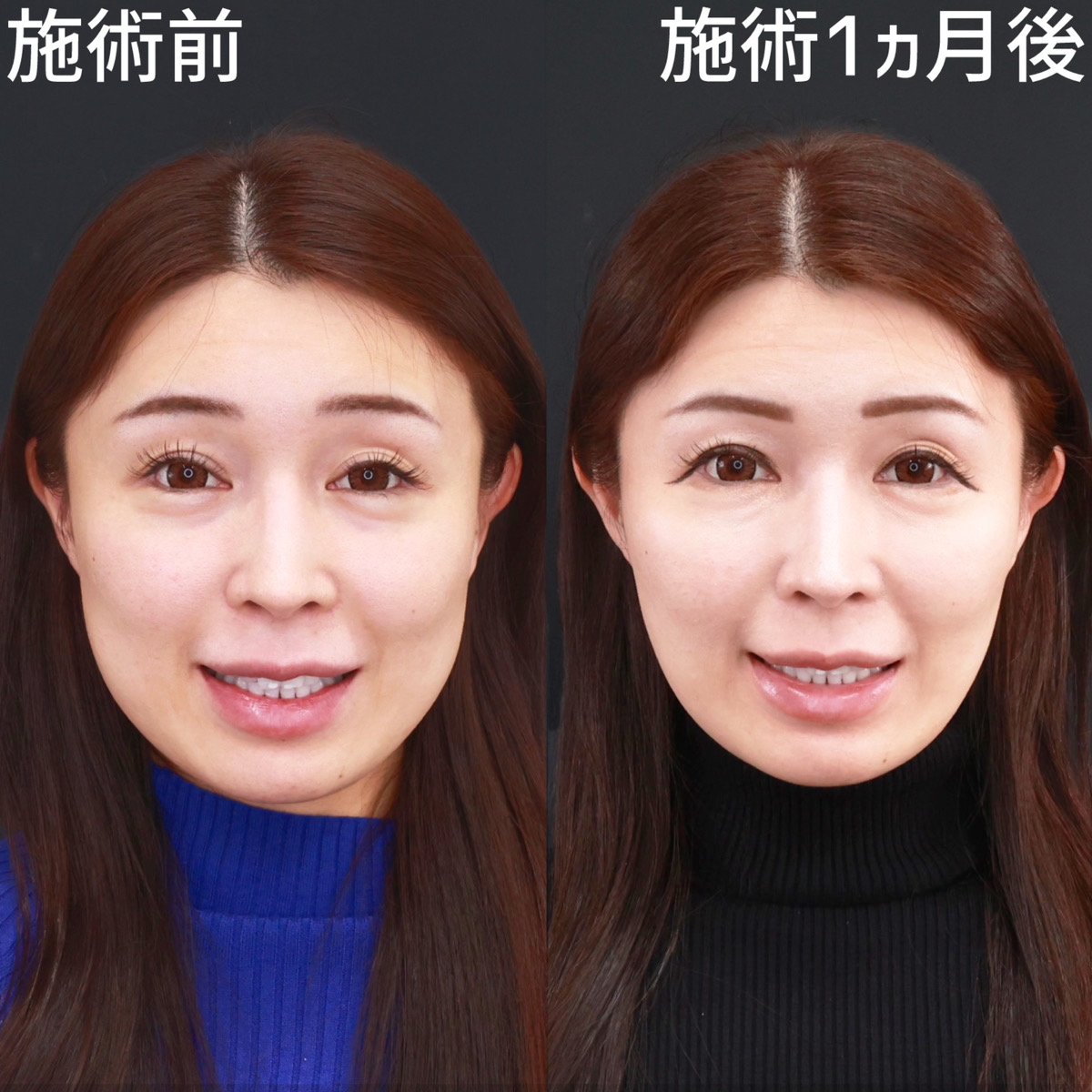 【バッカルファット除去】お顔のボリュームをスッキリ落とす！