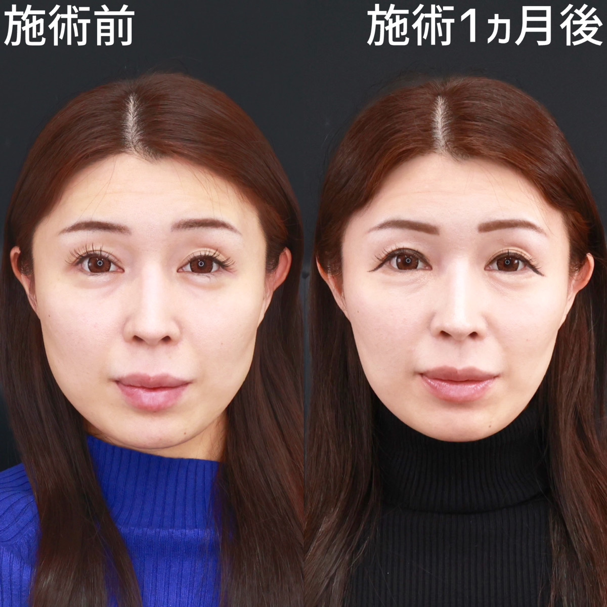 TAC式 ツヤ肌コラーゲンリフト®/バッカルファット除去/エラボトックス注射の症例写真 施術前後 