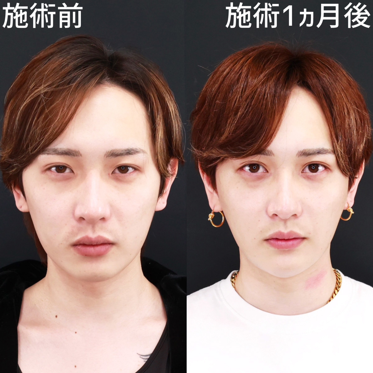 【小顔複合施術】脂肪吸引5部位でスッキリ小顔！メンズも垢抜け◎