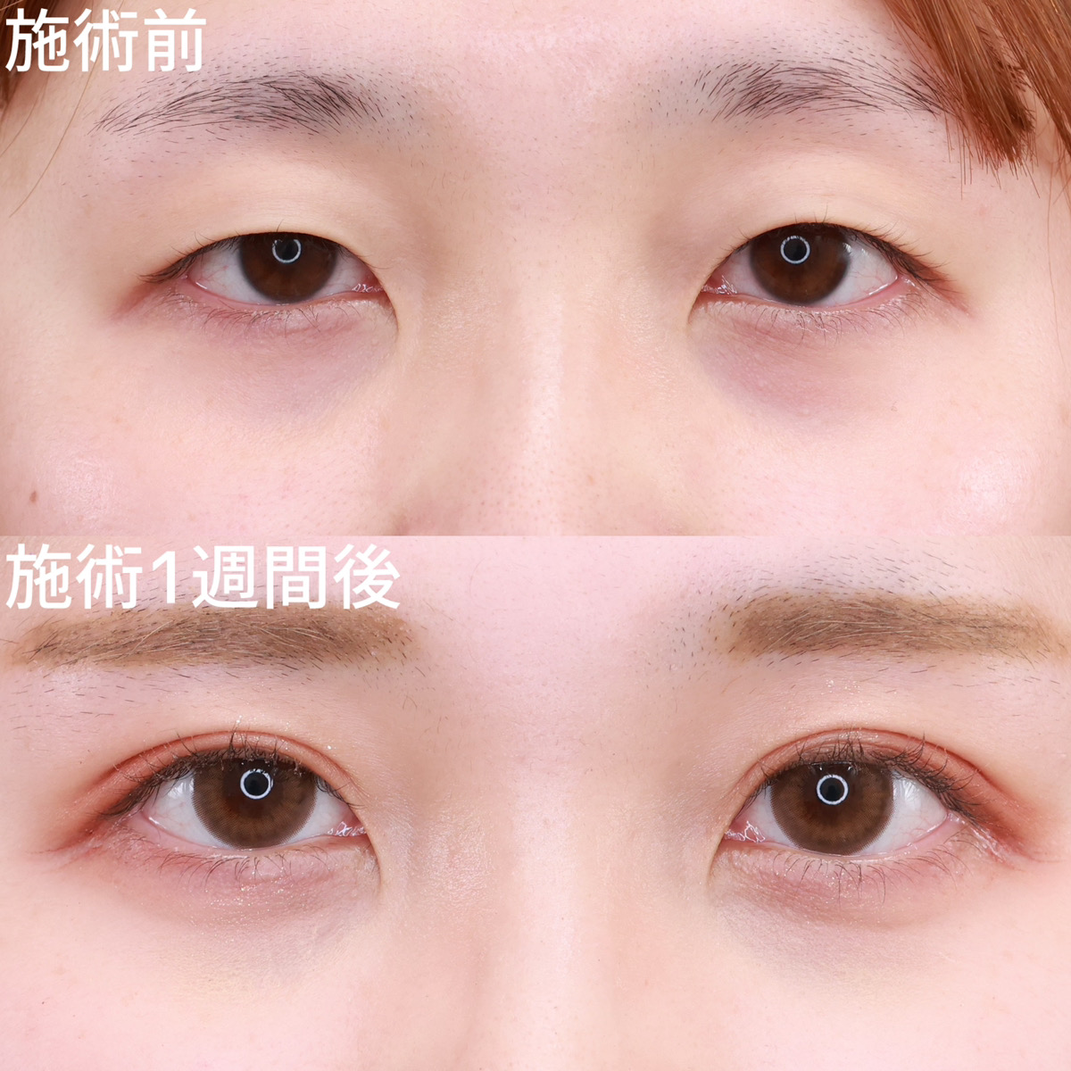 【クイックコスメリング】アイプチを卒業！憧れの平行二重に◎