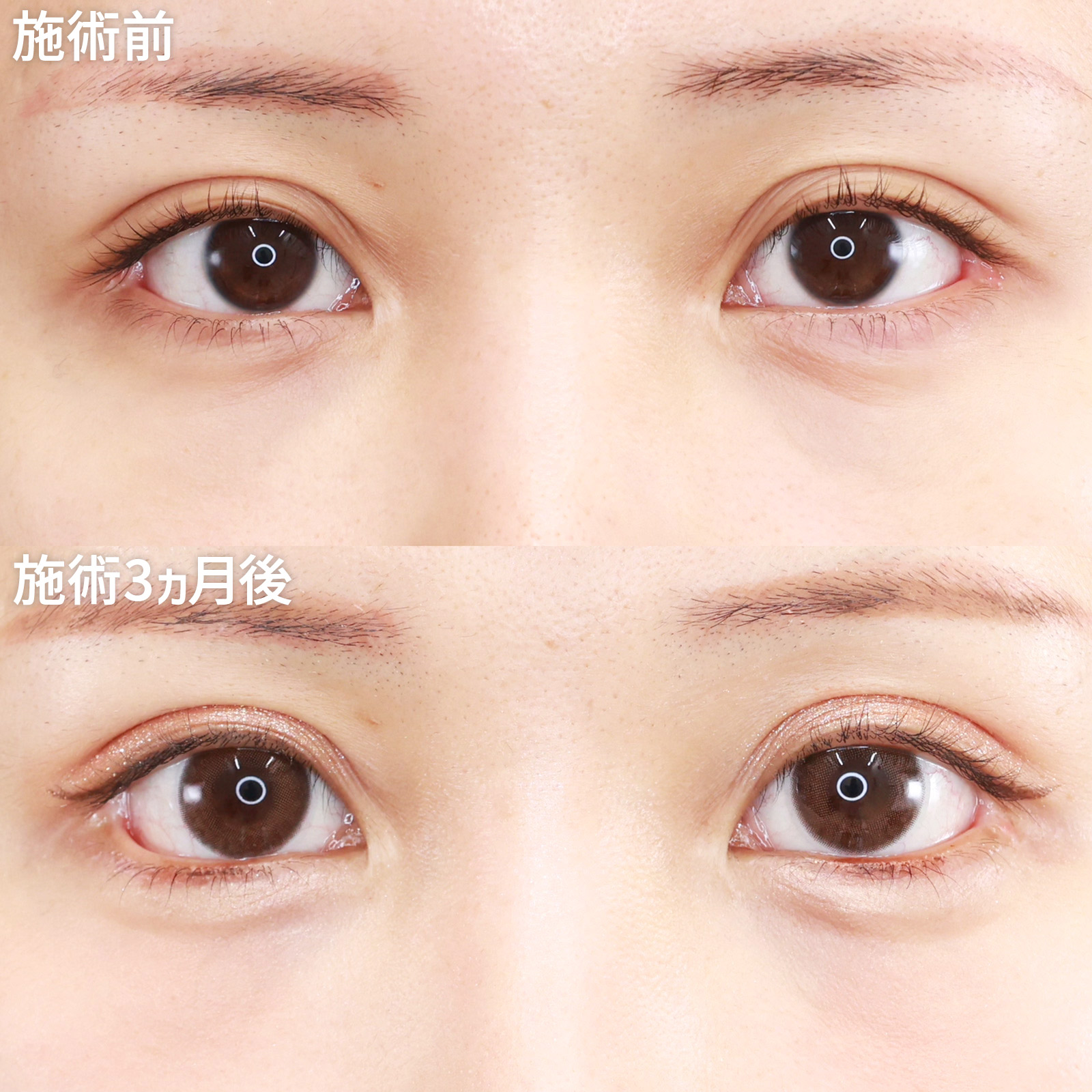 【グラマラスライン形成】下眼瞼を拡大して、アイドル級のデカ目に！