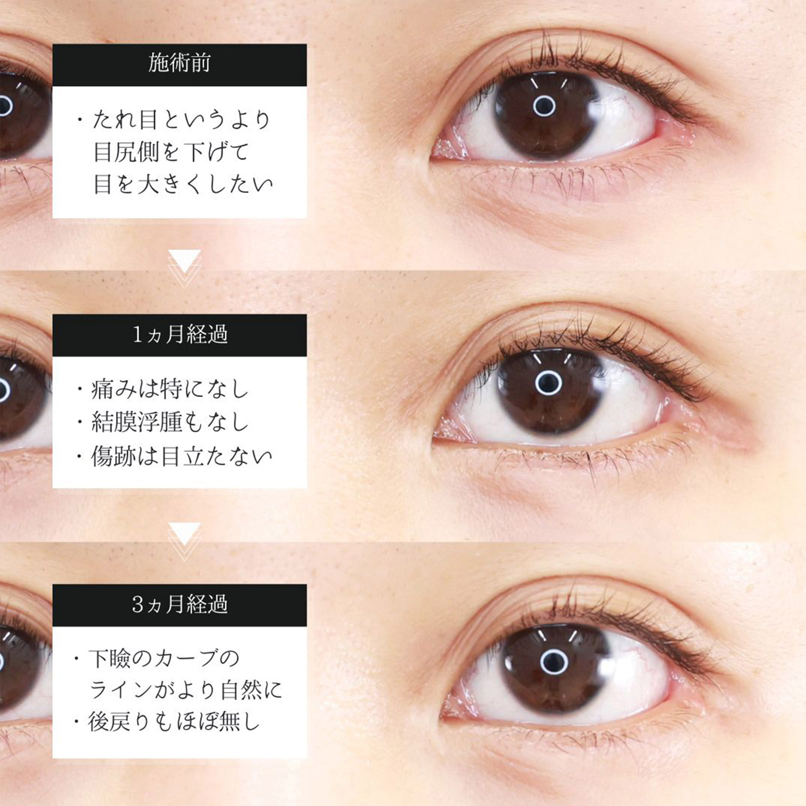 グラマラスライン（タレ目形成）の症例写真 施術前後 