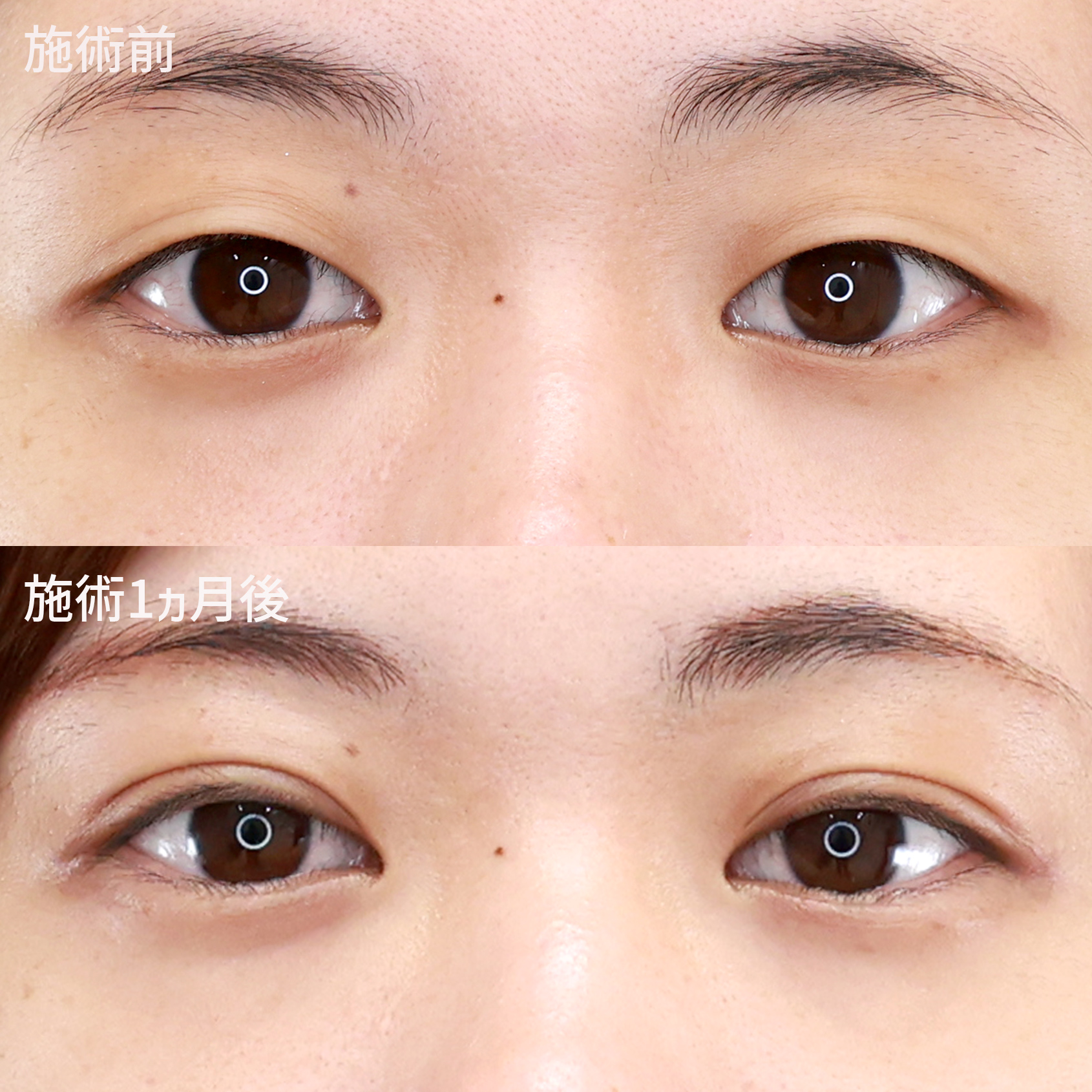 【二重埋没法1ヵ月後】瞬きしてもバレにくい自然な二重に