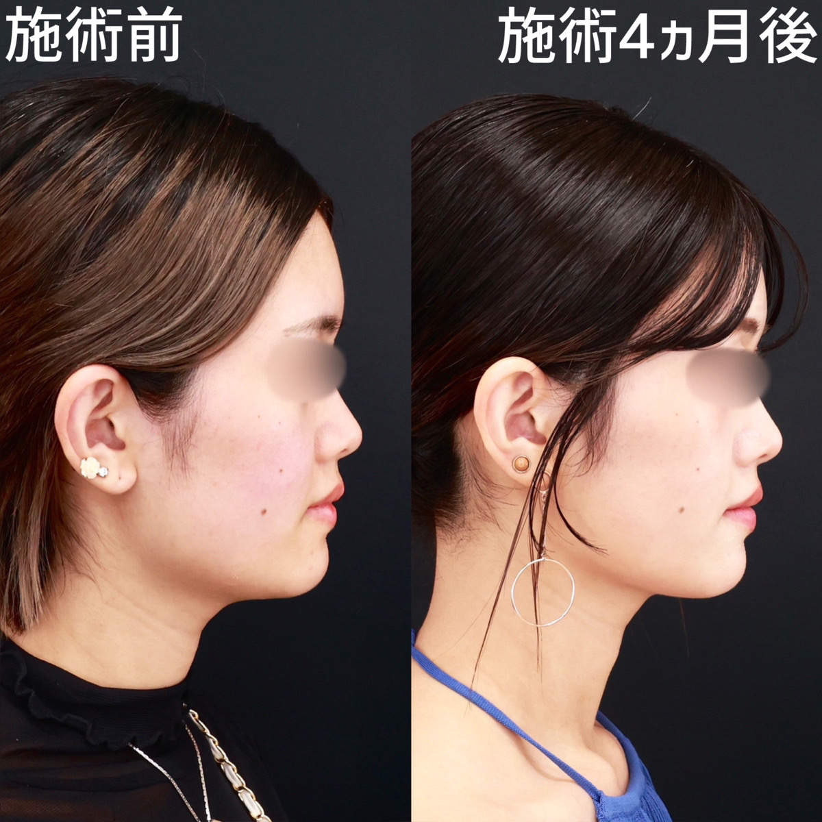 【顎下脂肪吸引】横から見てもスッキリ！二重顎を改善◎