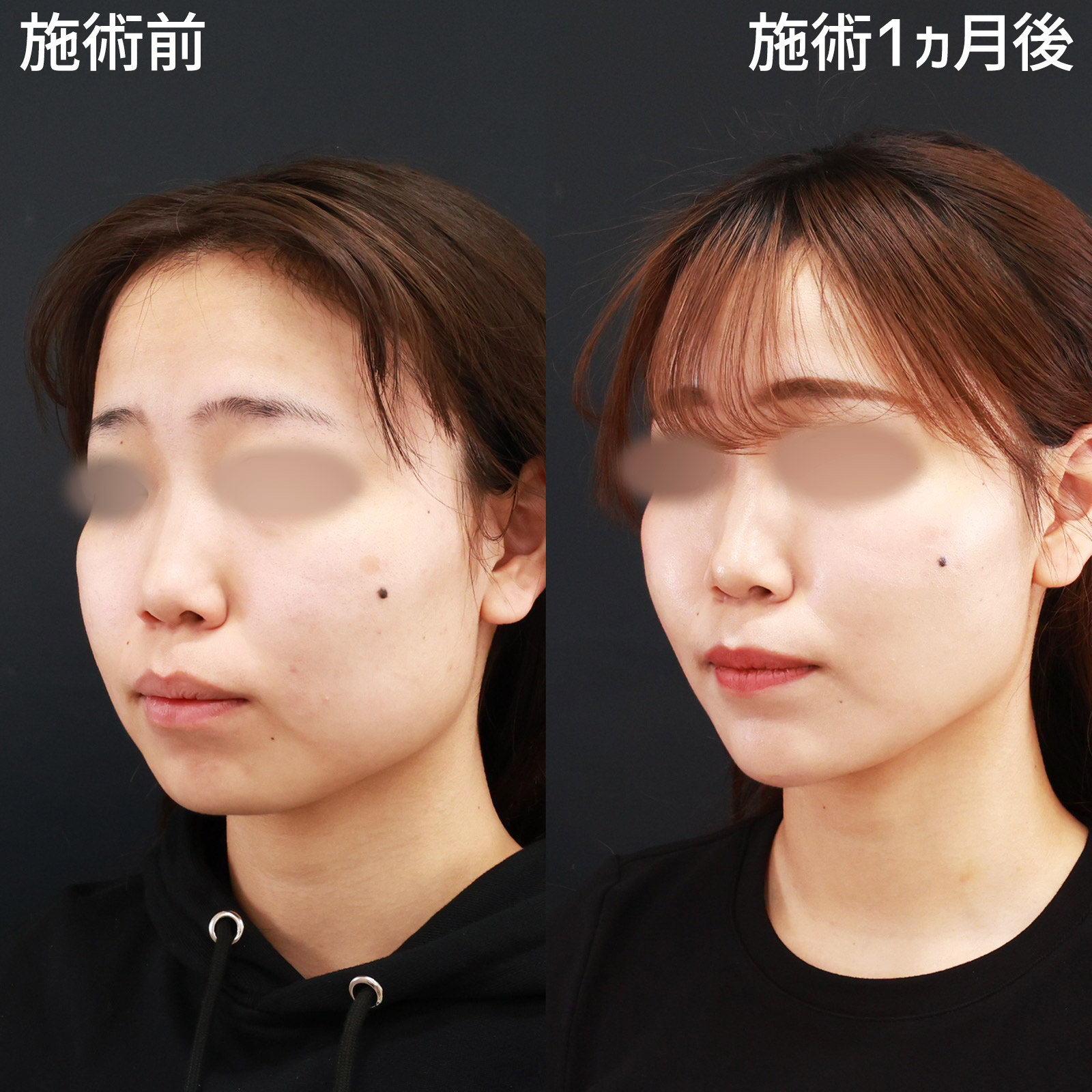 小顔整形｜パーフェクトフェイスライン/TAC式 ツヤ肌コラーゲンリフト®/バッカルファット除去の症例写真 施術前後 