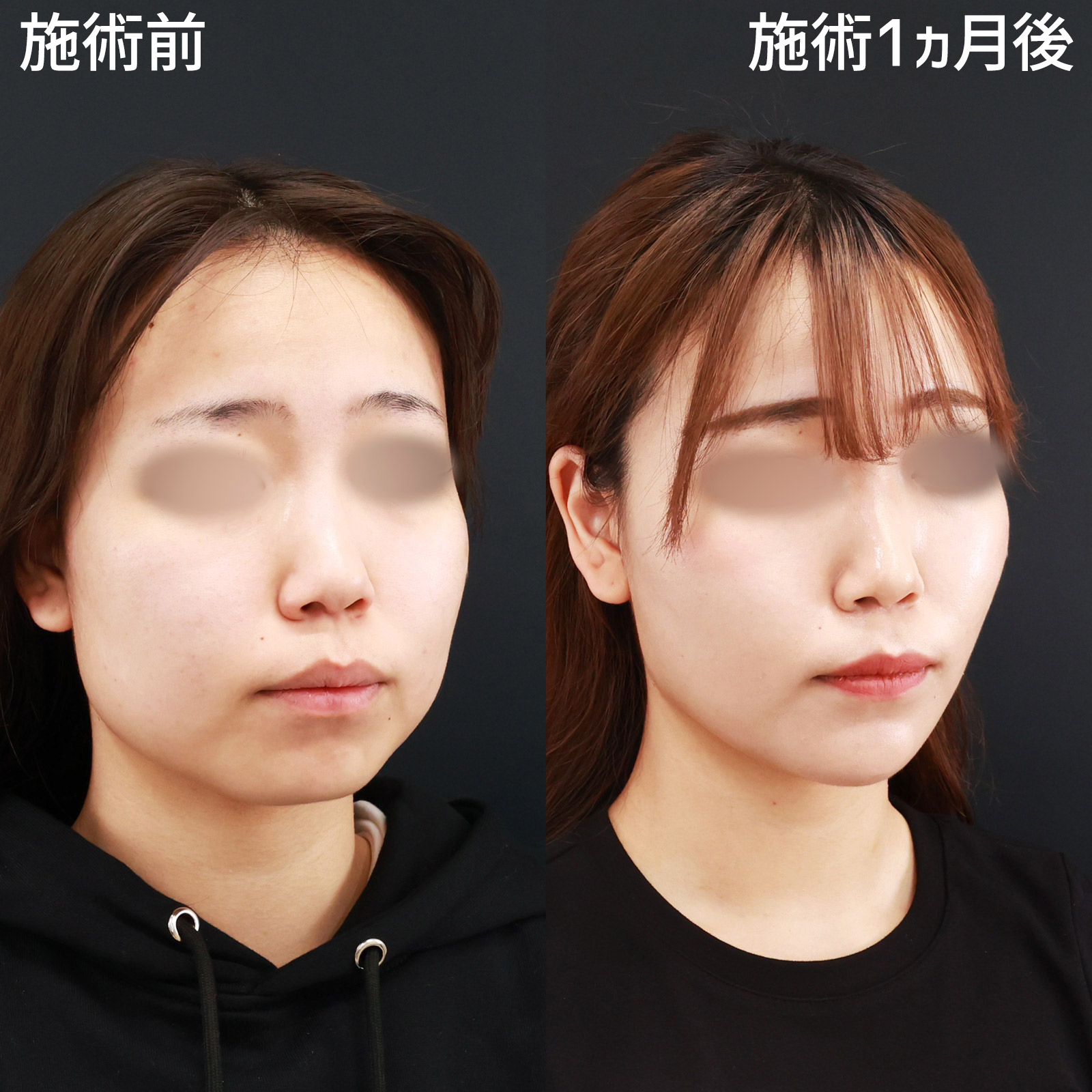 小顔整形｜パーフェクトフェイスライン/TAC式 ツヤ肌コラーゲンリフト®/バッカルファット除去の症例写真 施術前後 